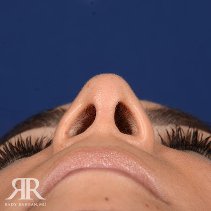 Female Rhinoplasty