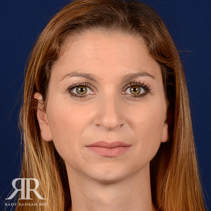 Female Rhinoplasty