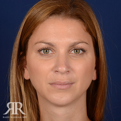 Female Rhinoplasty