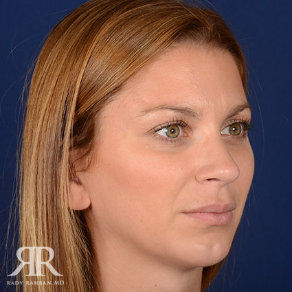 Female Rhinoplasty