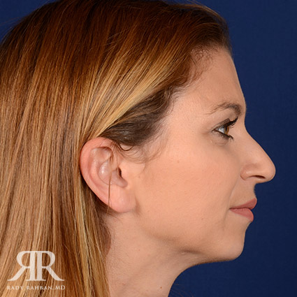 Female Rhinoplasty