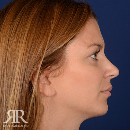 Female Rhinoplasty