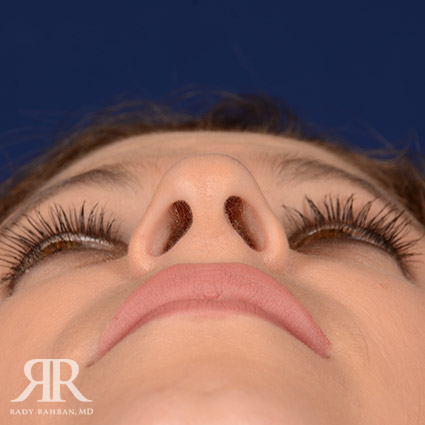 Female Rhinoplasty