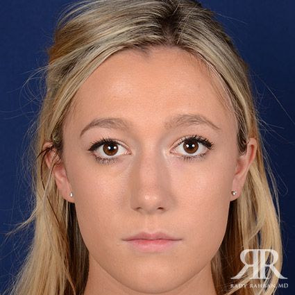 Female Rhinoplasty