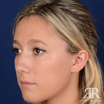 Female Rhinoplasty