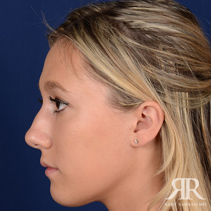 Female Rhinoplasty