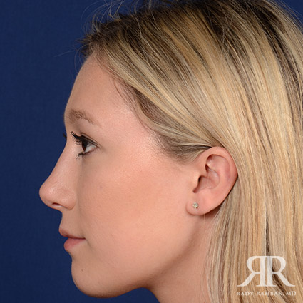 Female Rhinoplasty