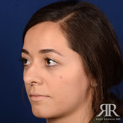 Female Rhinoplasty