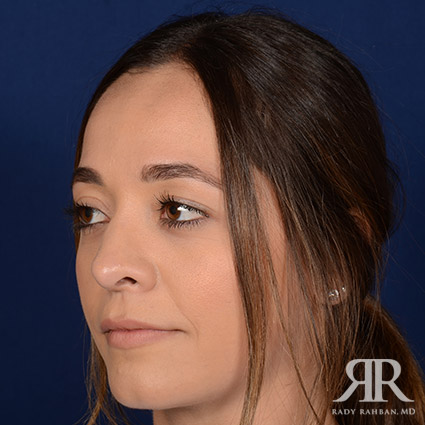 Female Rhinoplasty