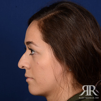 Female Rhinoplasty