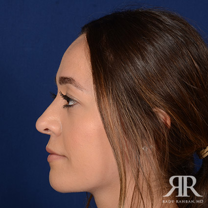 Female Rhinoplasty