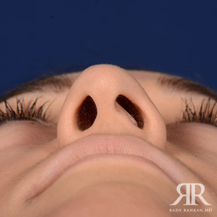 Female Rhinoplasty