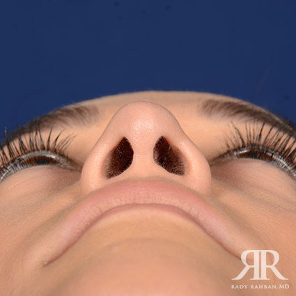 Female Rhinoplasty