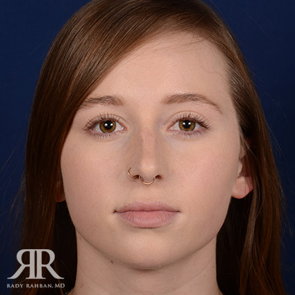 Female Rhinoplasty