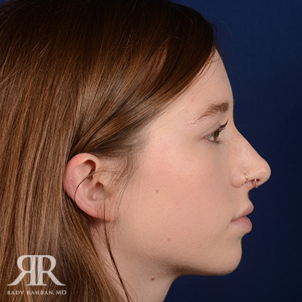 Female Rhinoplasty