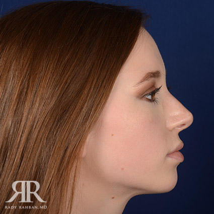 Female Rhinoplasty