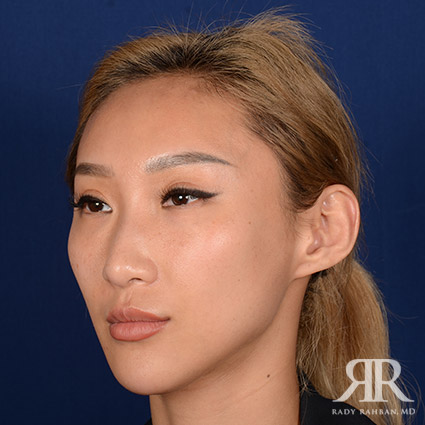 Female Rhinoplasty