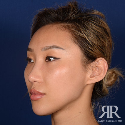 Female Rhinoplasty