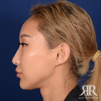 Female Rhinoplasty