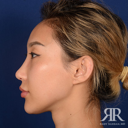 Female Rhinoplasty