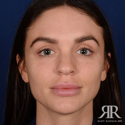 Female Rhinoplasty