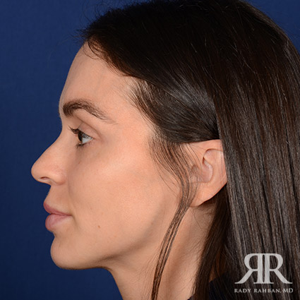 Female Rhinoplasty