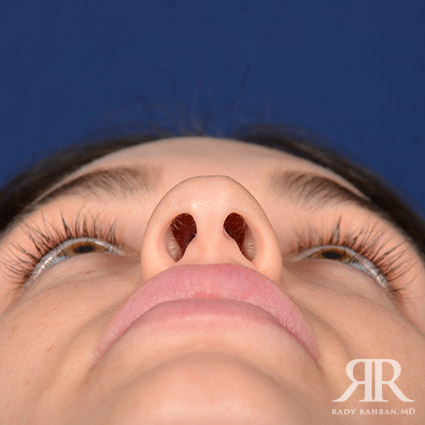 Female Rhinoplasty