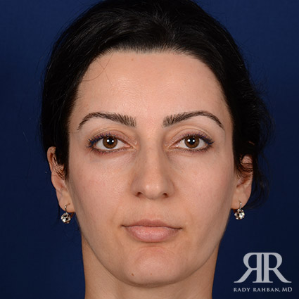 Female Rhinoplasty