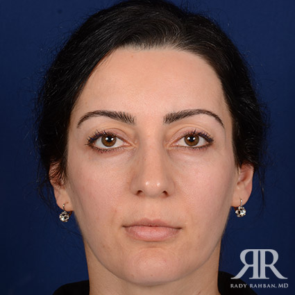 Female Rhinoplasty