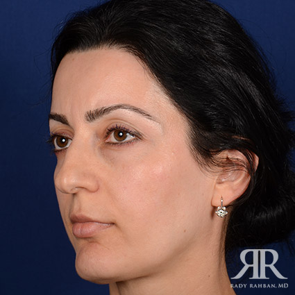 Female Rhinoplasty