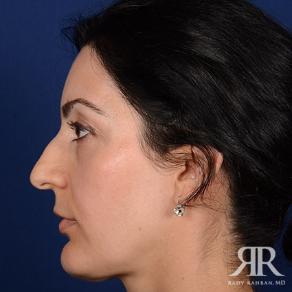 Female Rhinoplasty