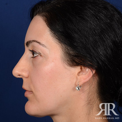 Female Rhinoplasty