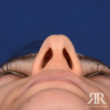 Female Rhinoplasty