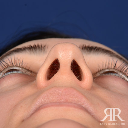 Female Rhinoplasty