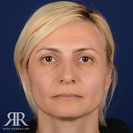 Female Rhinoplasty