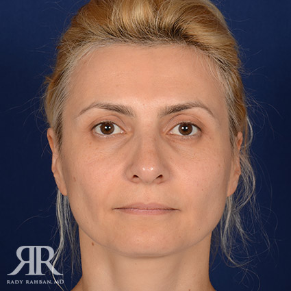 Female Rhinoplasty