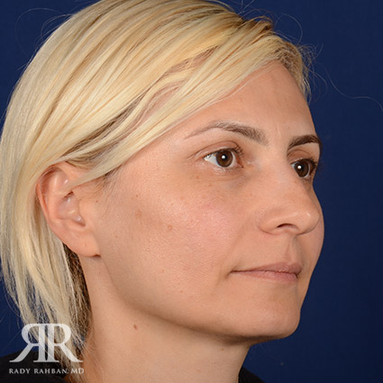 Female Rhinoplasty