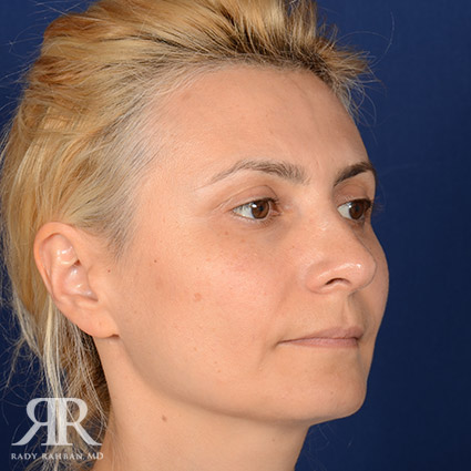 Female Rhinoplasty