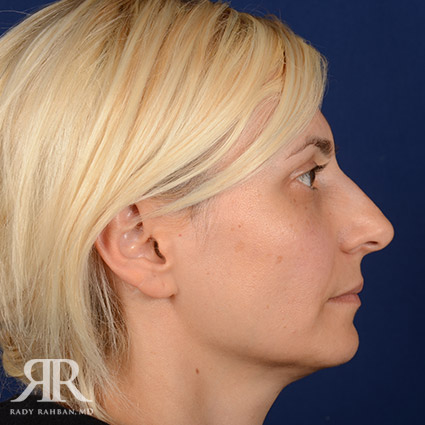 Female Rhinoplasty