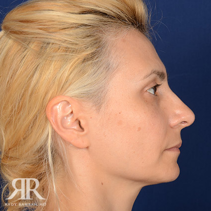 Female Rhinoplasty