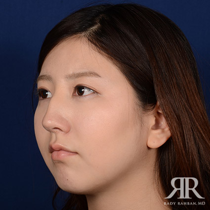 Female Rhinoplasty