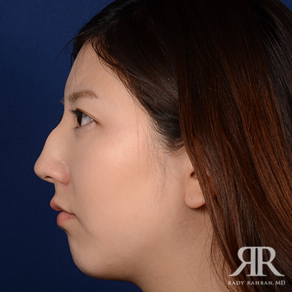 Female Rhinoplasty