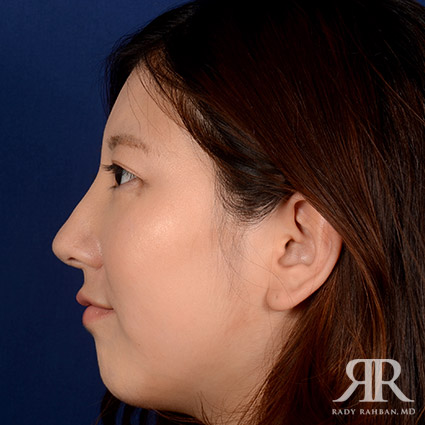 Female Rhinoplasty