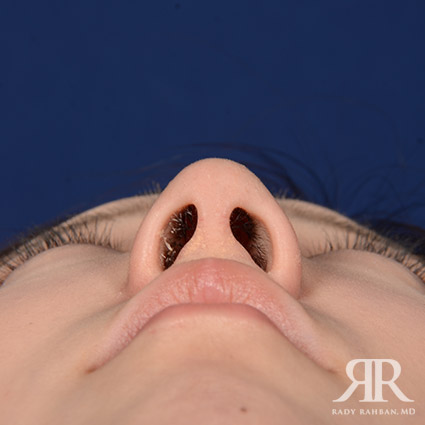 Female Rhinoplasty