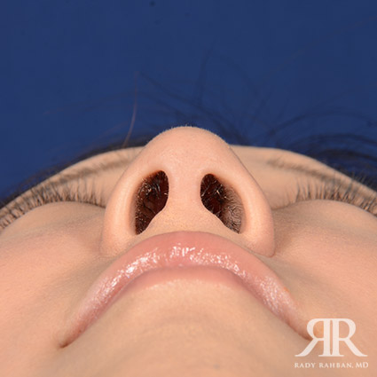 Female Rhinoplasty