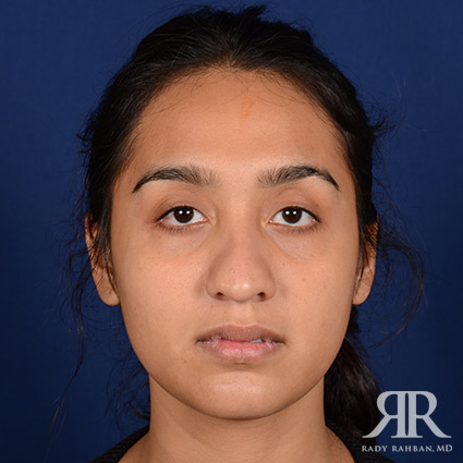 Female Rhinoplasty