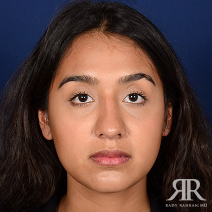 Female Rhinoplasty