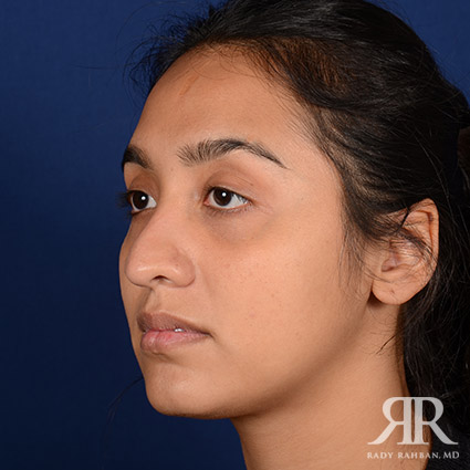 Female Rhinoplasty