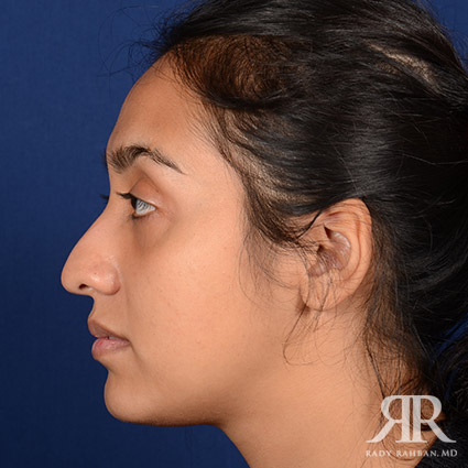 Female Rhinoplasty