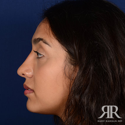 Female Rhinoplasty